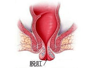 痔疮还在不断变大：痔疮犯了越来越大 