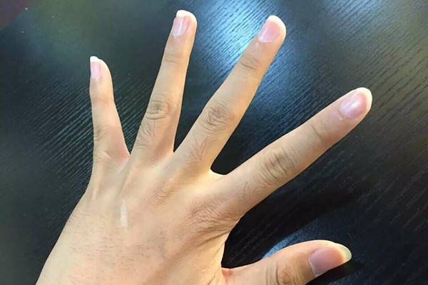 突发手指僵硬：突然手指头僵硬不能动 