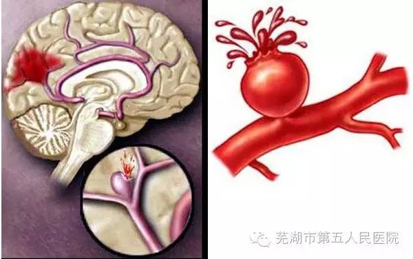 武汉脑出血紧急救援医院，守护生命的昼夜不息的战斗地
